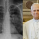 Cancer de pulmao pode nao apresentar sintomas alerta medico do A C Camargo ao explicar doenca do papa Leao XIV 80x80